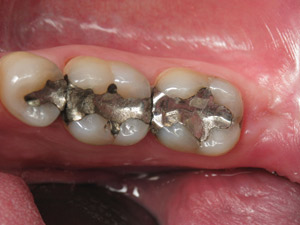 Teeth before the CEREC process