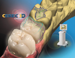CEREC Brochoure